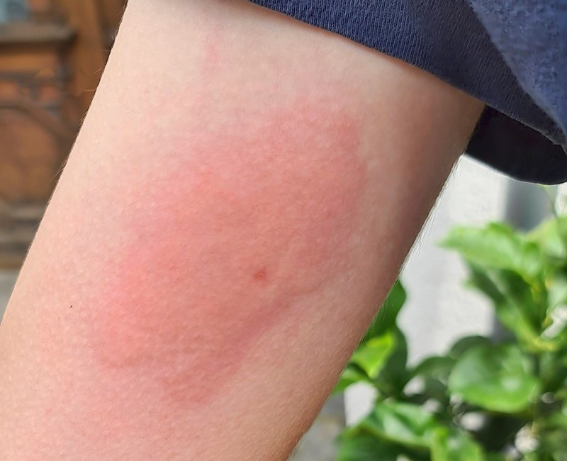 Wespenstiche zeichnen sich vor allem durch eine Schwellung rund um den Stichbereich aus.